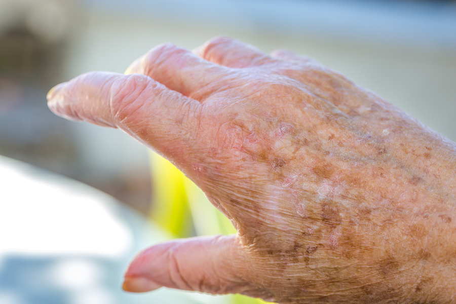 Senior Care in Squirrel Hill PA: Parkinson's Disease And Skin Cancer