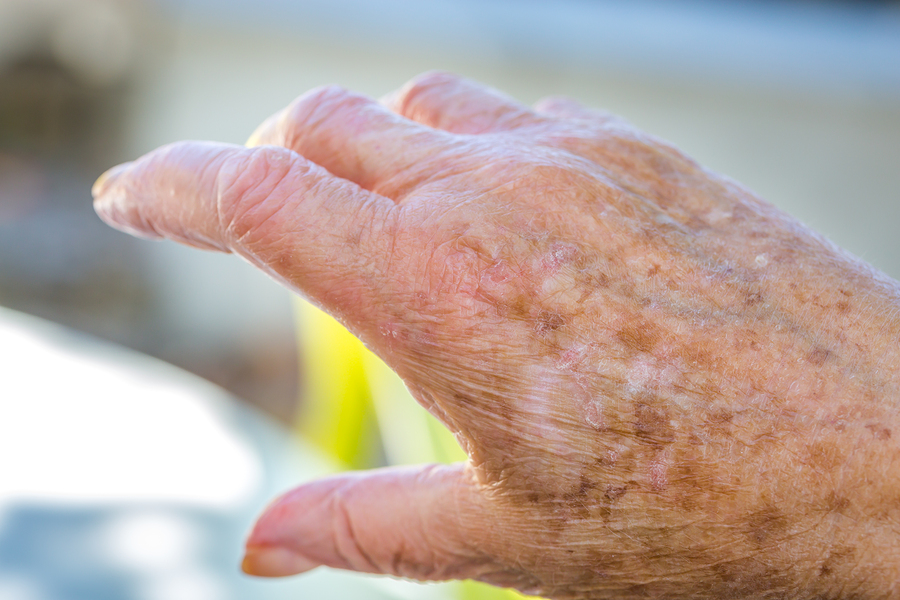 Home Care Services in Edgewood PA: Senior Dry Skin